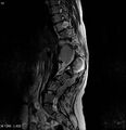 Neurofibromatosis type 2 - cranial and spinal involvement (Radiopaedia 5351-7112 B 12).jpg