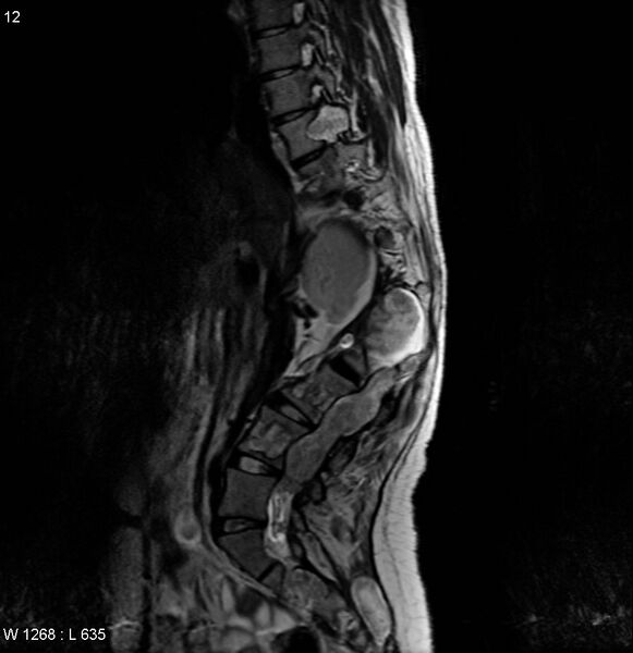 File:Neurofibromatosis type 2 - cranial and spinal involvement (Radiopaedia 5351-7112 B 12).jpg