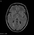 Neurosarcoidosis (Radiopaedia 10930-17204 Axial FLAIR 10).jpg