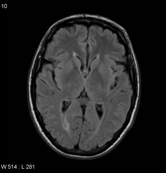 File:Neurosarcoidosis (Radiopaedia 10930-17204 Axial FLAIR 10).jpg