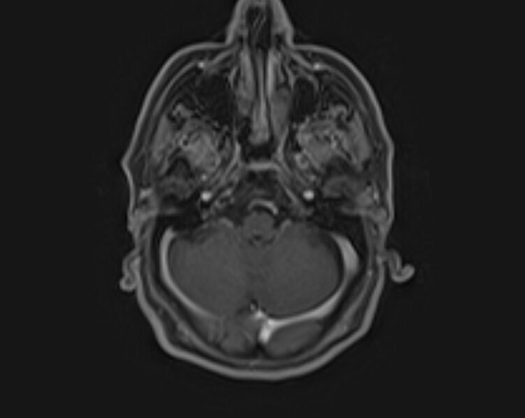File:Non-Hodgkin lymphoma - parotid gland (Radiopaedia 71531-81890 E 20).jpg