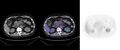 Non-Hodgkin lymphoma involving seminal vesicles with development of interstitial pneumonitis during Rituximab therapy (Radiopaedia 32703-33752 ax CT Fus PET 36).jpg
