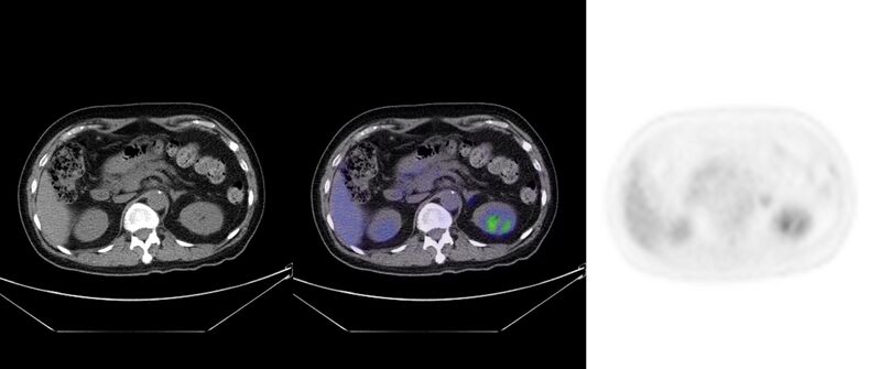 File:Non-Hodgkin lymphoma involving seminal vesicles with development of interstitial pneumonitis during Rituximab therapy (Radiopaedia 32703-33752 ax CT Fus PET 36).jpg