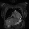 Non-compaction of the left ventricle (Radiopaedia 38868-41062 Coronal SSFP 2D FS 13).jpg