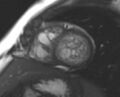 Non-compaction of the left ventricle (Radiopaedia 69436-79314 Short axis cine 96).jpg