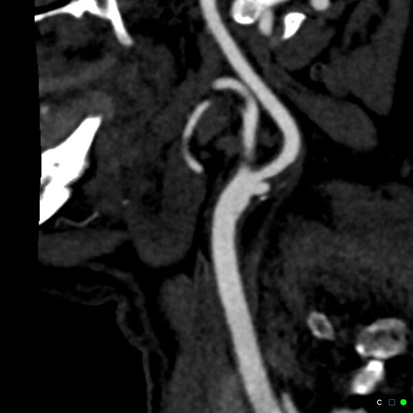 File:Non-occlusive intraluminal internal carotid artery thrombus (Radiopaedia 37751-39658 C 57).jpg