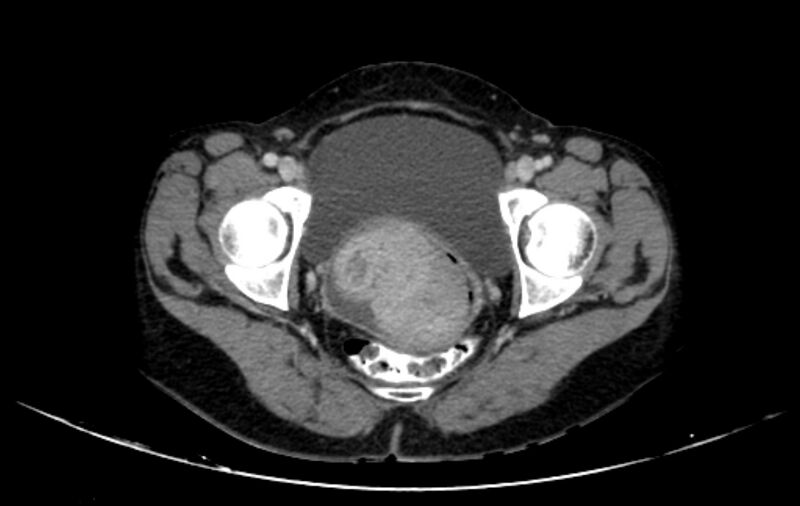 File:Non-puerperal uterine inversion (Radiopaedia 78343-91094 A 57).jpg