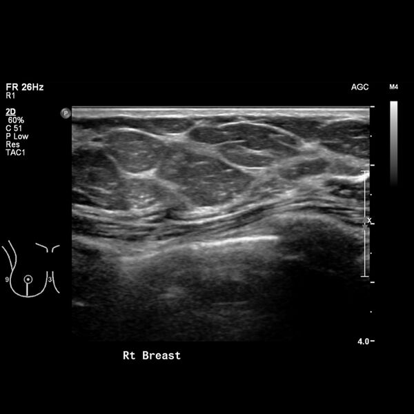 File:Normal breast mammography (tomosynthesis) and ultrasound (Radiopaedia 65325-74354 Right breast 7).jpeg