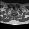 Normal cervical and thoracic spine MRI (Radiopaedia 35630-37156 Axial T1 7).png
