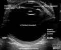 Normal eye ultrasound (Radiopaedia 70415-80515 A 1).png