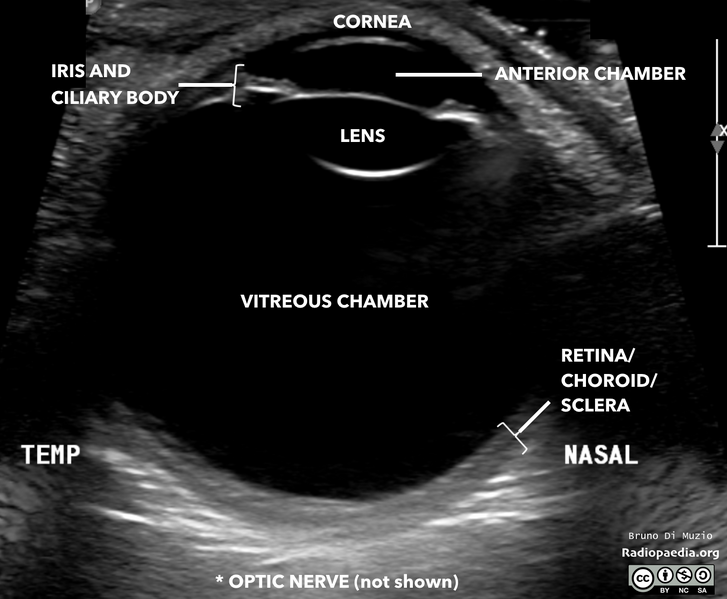 File:Normal eye ultrasound (Radiopaedia 70415-80515 A 1).png
