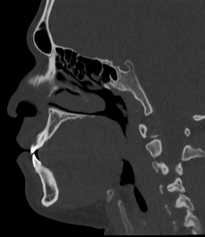 Normal facial bone CT (Radiopaedia 88742-105476 Sagittal bone window 79).jpg