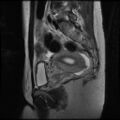 Normal female pelvis MRI (retroverted uterus) (Radiopaedia 61832-69933 Sagittal T2 21).jpg