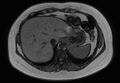 Normal liver MRI with Gadolinium (Radiopaedia 58913-66163 B 26).jpg