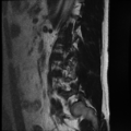Normal lumbar spine MRI (Radiopaedia 35543-37039 Sagittal T2 1).png