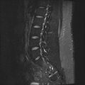 Normal lumbar spine MRI (Radiopaedia 47857-52609 Sagittal STIR 14).jpg