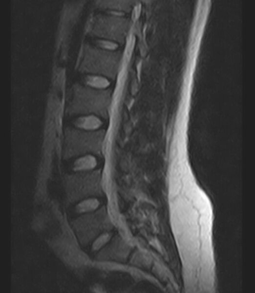 File:Normal lumbar spine MRI - low-field MRI scanner (Radiopaedia 40976-43699 Sagittal T2 5).jpg