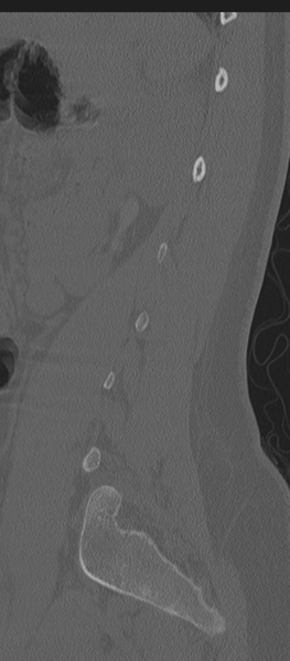 File:Normal lumbosacral CT (Radiopaedia 37923-39867 Sagittal bone window 24).png