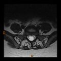 Normal spine MRI (Radiopaedia 77323-89408 Axial T2 24).jpg