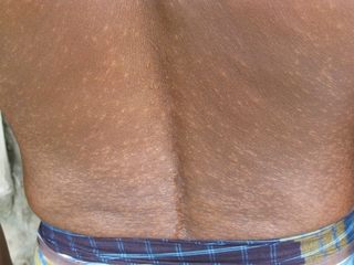 Hypopigmented papules are seen on the patient's back. The lesions are roughly symmetrical, a common characteristic of post-kala-azar dermal leishmaniasis (PKDL), and are painless and non- pruritic.