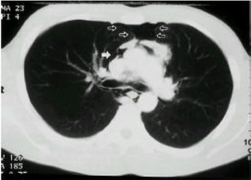 CT scan showed pneumomediastinum blank arrow (and pneumopericardium)