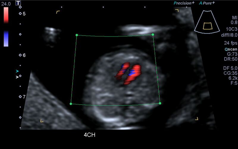 File:1st trimester nuchal-morphology ultrasound (Radiopaedia 44706-48477 Heart views cine with colour 31).jpg