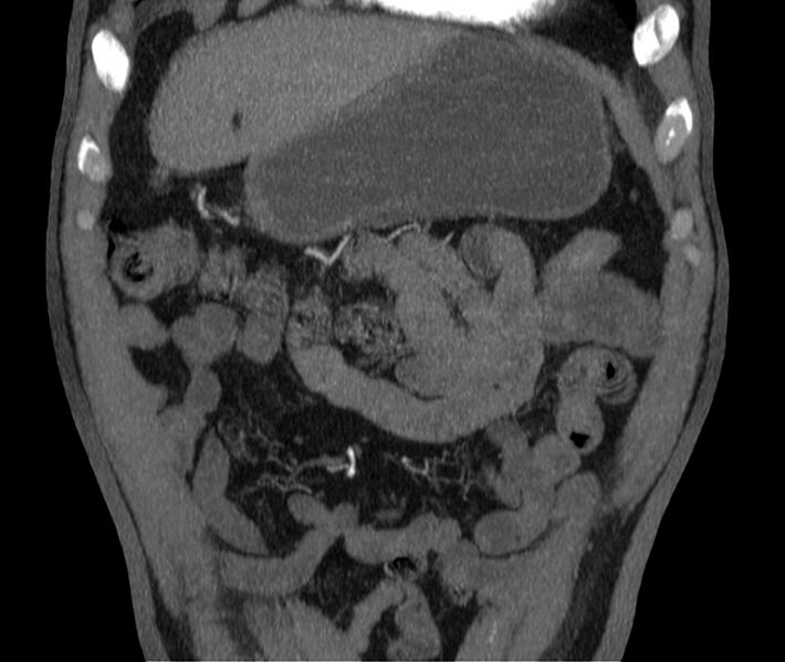 File:Abdominal aortic aneurysm (Radiopaedia 22421-22458 C 2).jpg