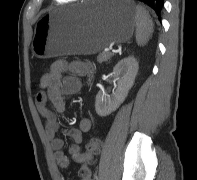 File:Abdominal aortic aneurysm (Radiopaedia 22421-22458 D 33).jpg