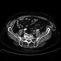 Abdominal aortic aneurysm (Radiopaedia 25855-26001 Axial C+ arterial phase 100).jpg