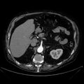Abdominal aortic aneurysm (Radiopaedia 25855-26001 Axial C+ arterial phase 42).jpg