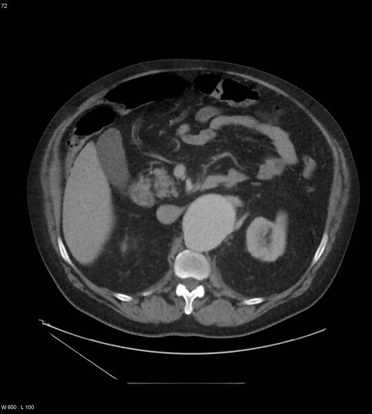 File:Abdominal aortic aneurysm with intramural hematoma then rupture (Radiopaedia 50278-55631 Axial C+ arterial phase 63).jpg