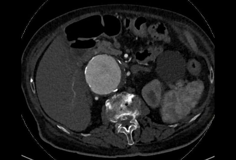 File:Abdominal aortic aneurysm with thrombus fissuration (Radiopaedia 73192-83919 Axial C+ arterial phase 50).jpg