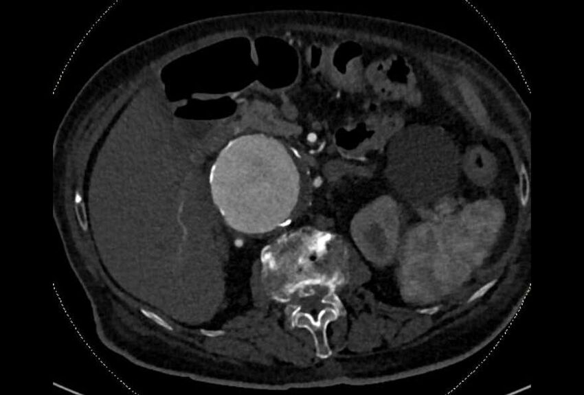 Abdominal aortic aneurysm with thrombus fissuration (Radiopaedia 73192-83919 Axial C+ arterial phase 50).jpg