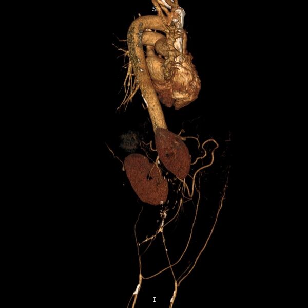 File:Abdominal aortic interposition tube graft and aneurysm thrombosis (Radiopaedia 71438-81857 3D VRT C+ arterial phase 12).jpg