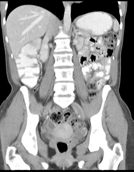 File:Abdominal desmoid tumor (Radiopaedia 41007-43740 Coronal C+ portal venous phase 24).png