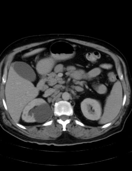 File:Abdominal lymphoma - with sandwich sign (Radiopaedia 53486-59492 Axial C+ portal venous phase 17).jpg