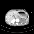 Abdominal multi-trauma - devascularised kidney and liver, spleen and pancreatic lacerations (Radiopaedia 34984-36486 Axial C+ portal venous phase 24).png