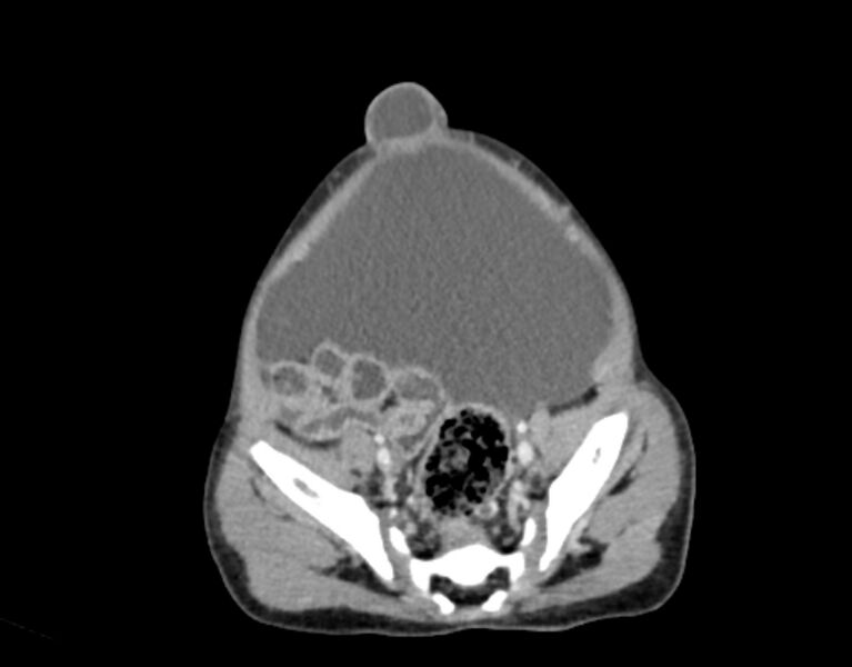 File:Abdominal premesenteric cystic lymphangioma (Radiopaedia 82995-97350 Axial C+ portal venous phase 54).jpg