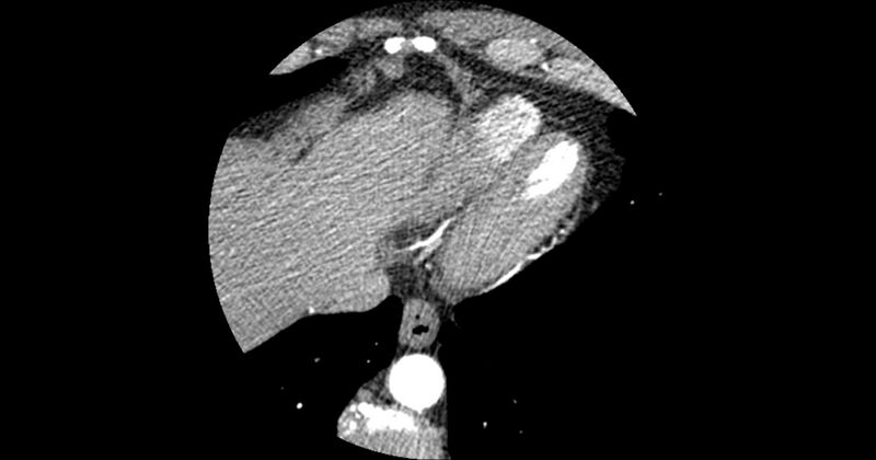 File:Aberrant left main coronary artery (ALMCA) arising from the right sinus with interarterial course (Radiopaedia 63251-71814 Axial C+ arterial phase 176).JPG