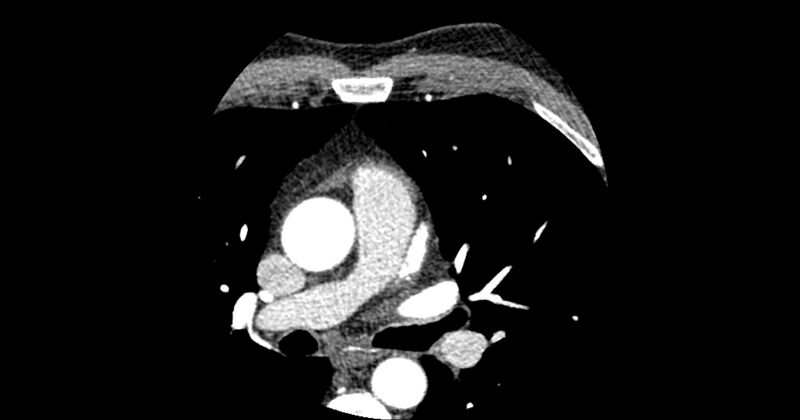 File:Aberrant left main coronary artery (ALMCA) arising from the right sinus with interarterial course (Radiopaedia 63251-71814 Axial C+ arterial phase 32).JPG