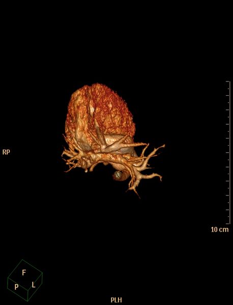 File:Aberrant left pulmonary artery (pulmonary sling) (Radiopaedia 42323-45435 3D reconstruction C+ CTPA 11).jpg