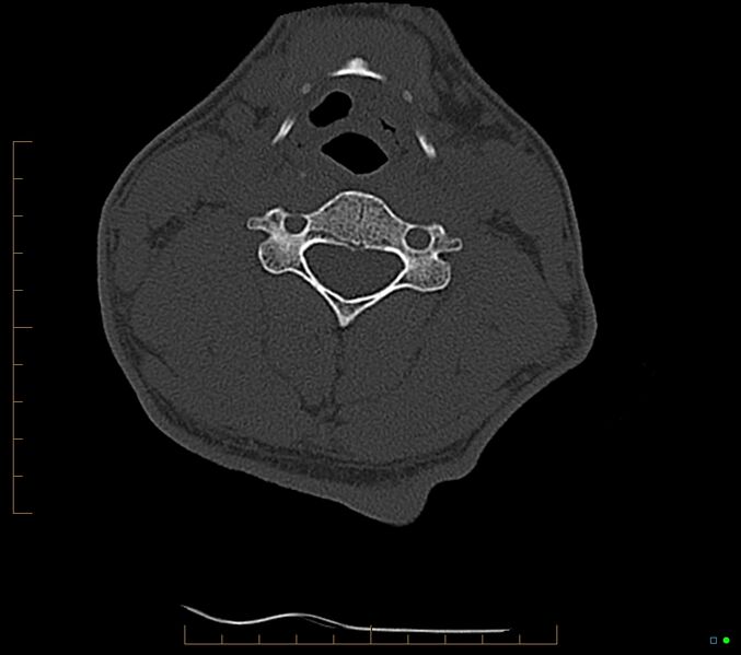 File:Accessory articulation of cervical transverse processes (Radiopaedia 82715-96933 Axial non-contrast 69).jpg