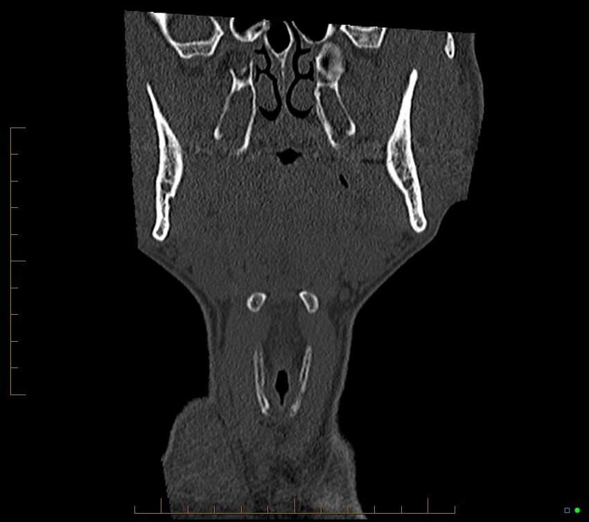 Accessory articulation of cervical transverse processes (Radiopaedia 82715-96933 Coronal non-contrast 15).jpg