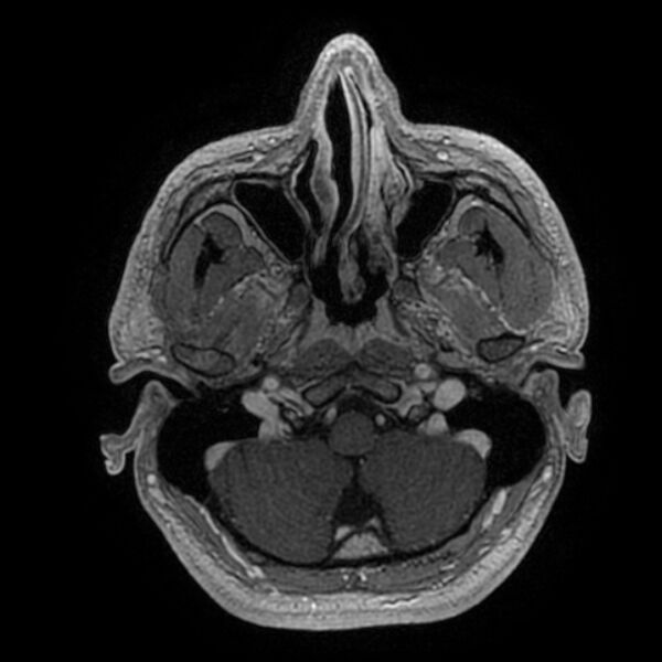 File:Acoustic schwannoma - intracanalicular (Radiopaedia 37247-39024 Axial T1 C+ 41).jpg
