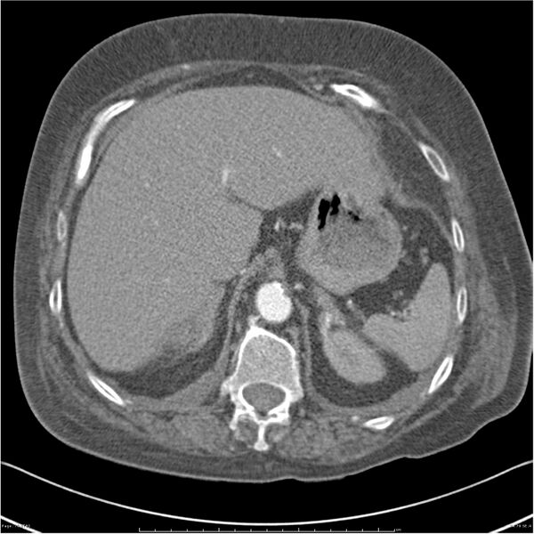 File:Acute-on-chronic pulmonary emboli (Radiopaedia 27925-28169 C+ CTPA 79).jpg