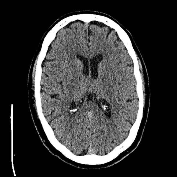File:Acute A3 occlusion with ACA ischemic penumbra (CT perfusion) (Radiopaedia 72036-82525 Axial non-contrast thins 47).jpg