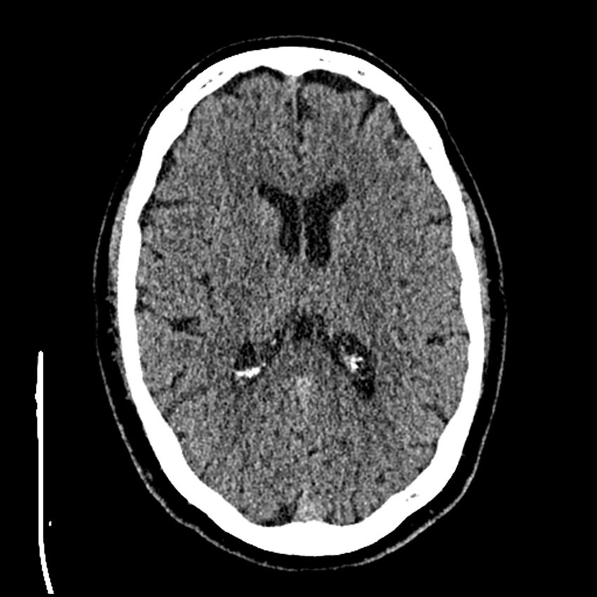 Acute A3 occlusion with ACA ischemic penumbra (CT perfusion) (Radiopaedia 72036-82525 Axial non-contrast thins 47).jpg