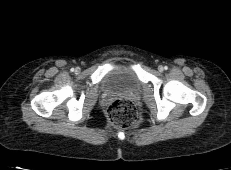 File:Acute Budd-Chiari syndrome (Radiopaedia 60858-68638 Axial C+ portal venous phase 295).jpg