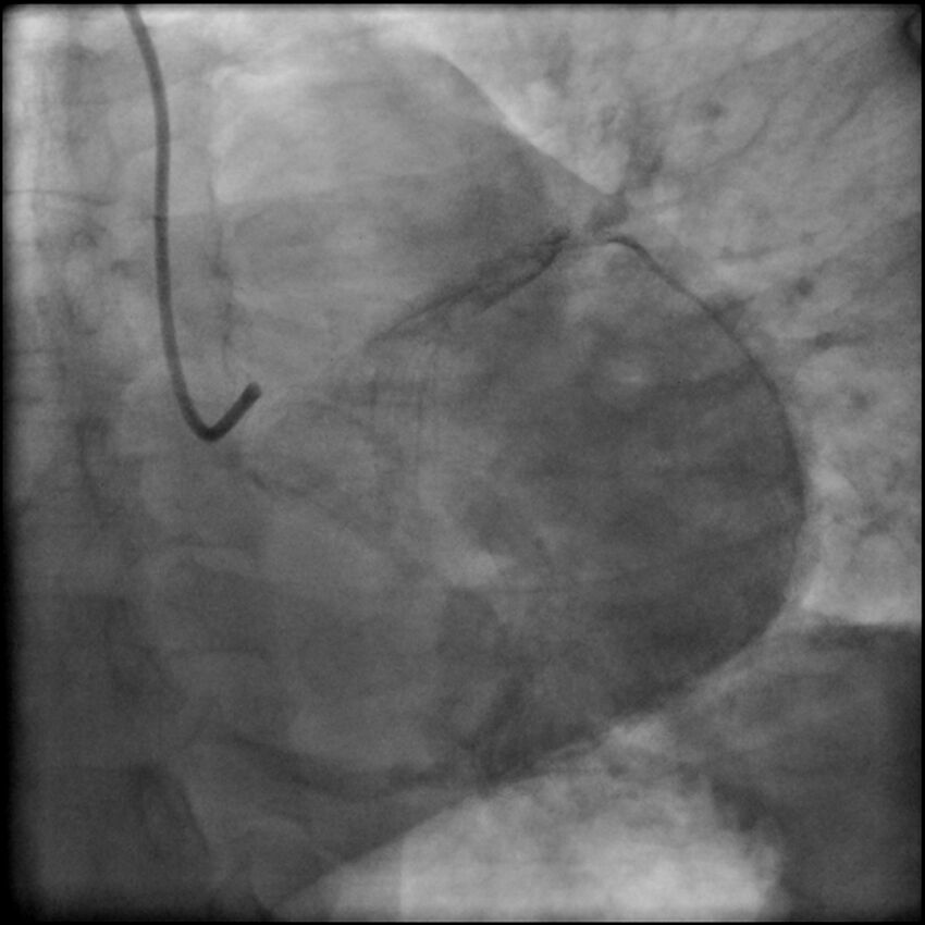 Acute anteroseptal myocardial infarction (Radiopaedia 68409-77946 LAO caudal (spider view) LAD and CX 77).jpg