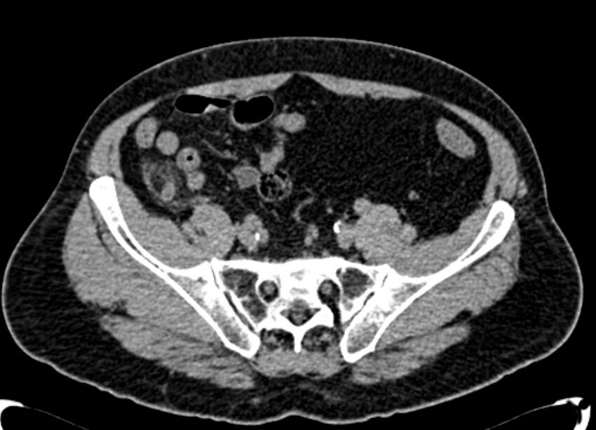 Acute appendicitis (Radiopaedia 13030-13091 Axial non-contrast 41).jpg